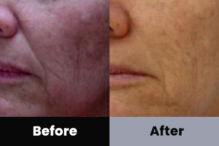 Anti-Aging Treatment Before and After Photos at Bare Body Shop in Omaha NE