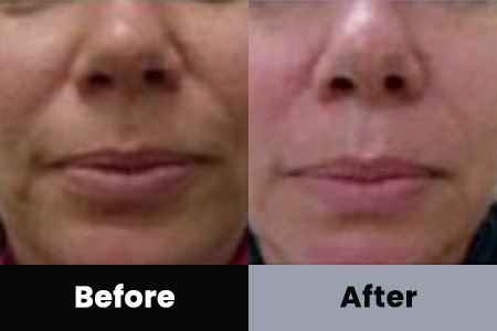 Anti-Aging Treatment Before and After Photos at Bare Body Shop in Omaha NE