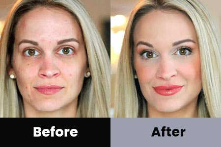 Anti-Aging Treatment Before and After Photos at Bare Body Shop in Omaha NE