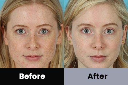 Anti-Aging Treatment Before and After Photos at Bare Body Shop in Omaha NE