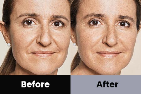 Dermal Fillers Treatment Before and After Photos at Bare Body Shop in Omaha NE