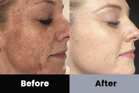 Dermaplaning Before and After Photos at Bare Body Shop in Omaha NE