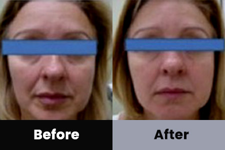 Before and After Image: Anti-Aging - front