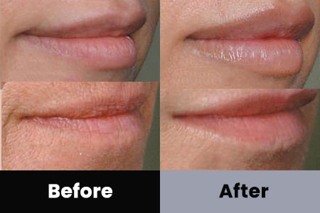 Before and After Image: Dermal Filler - right-front-oblique