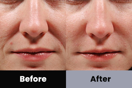 Before and After Image: Dermal Filler - front